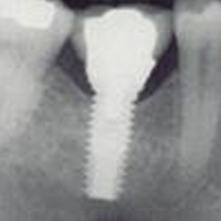 Despre implanturi dentare